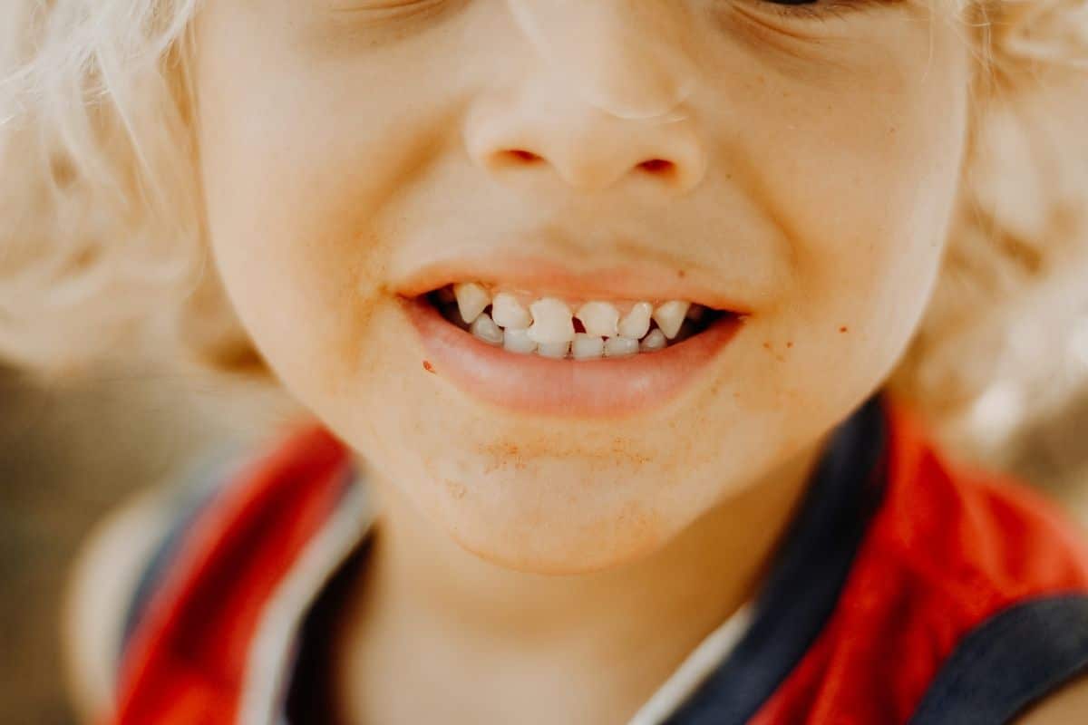 Dientes Conoides y Microdoncia