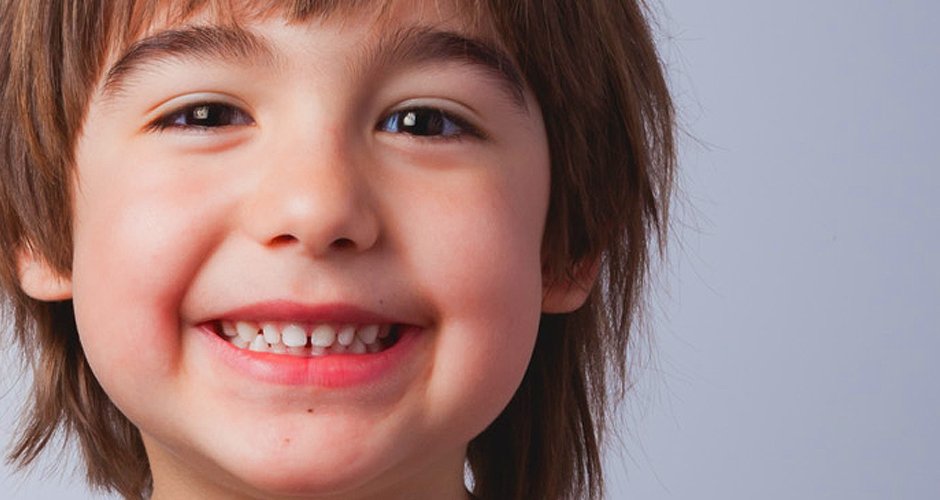Dientes Conoides y Microdoncia: Guía Completa para Recuperar la Armonía de tu Sonrisa