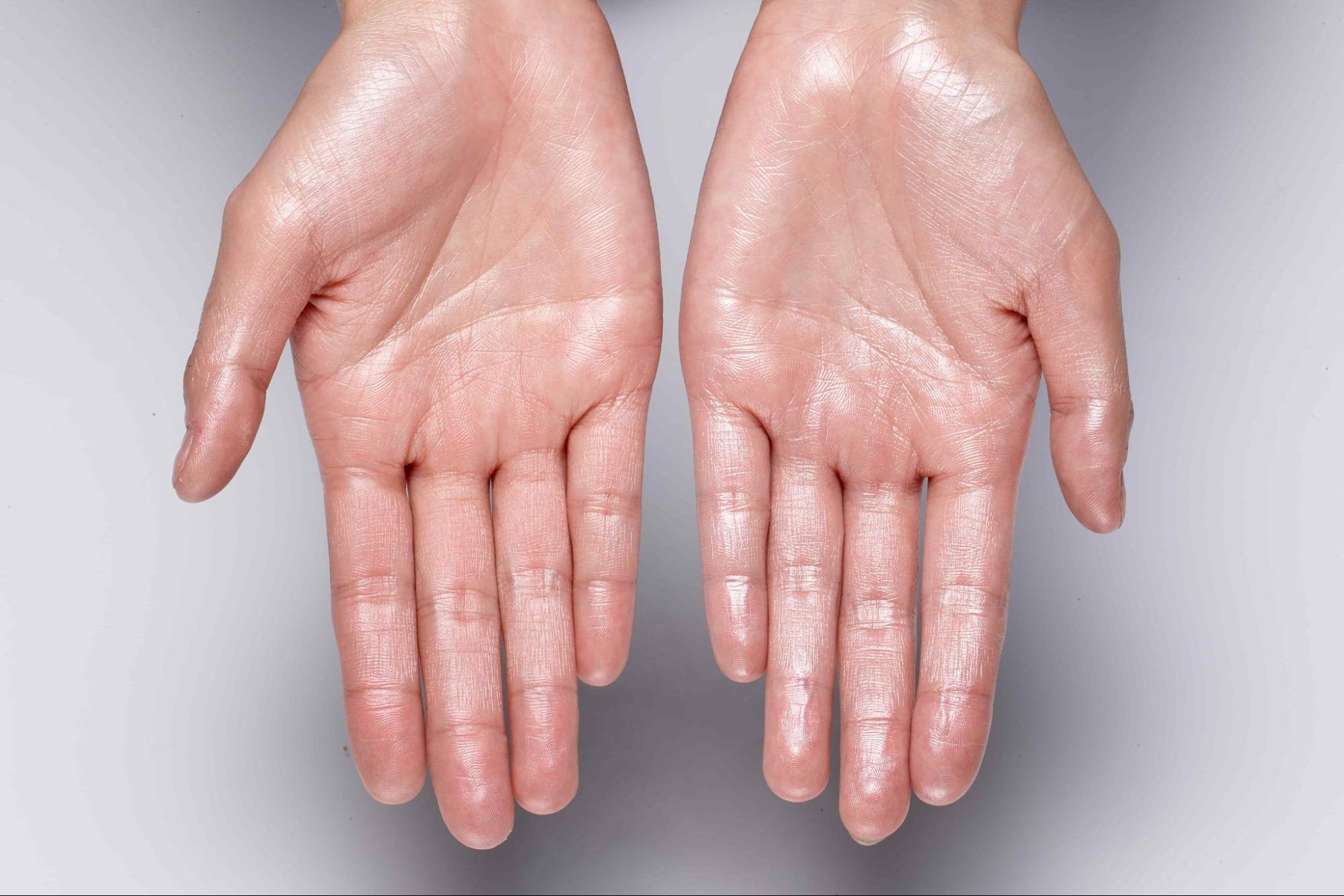 Tratamiento Hiperhidrosis