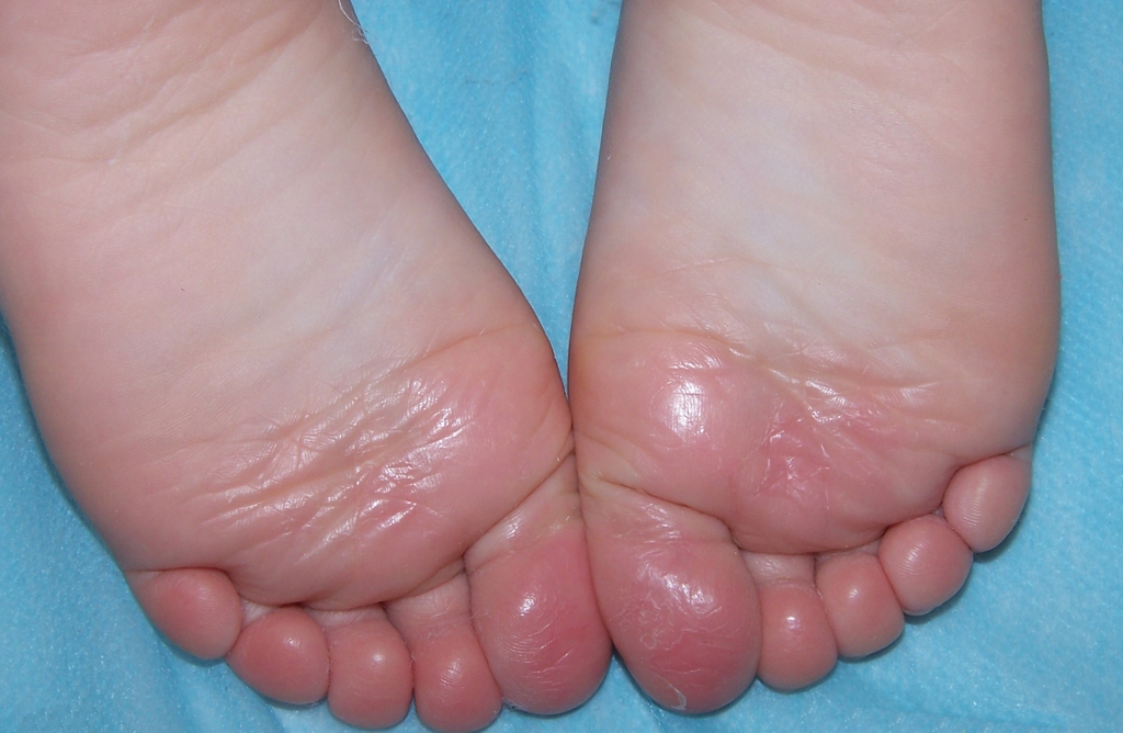 Tratamiento Hiperhidrosis