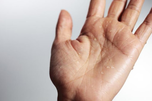 Tratamiento Hiperhidrosis
