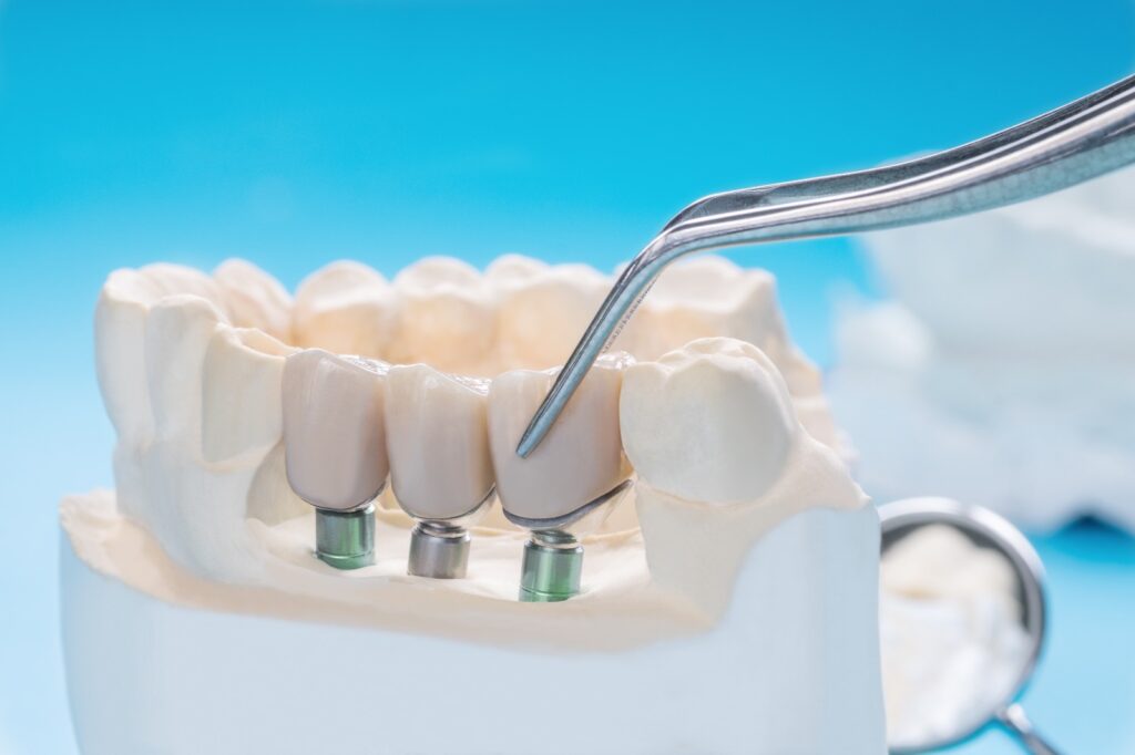 Coronas sobre Implantes