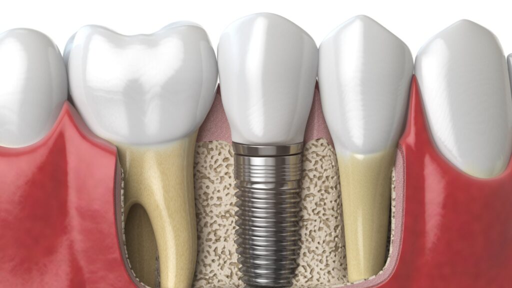 Coronas sobre Implantes