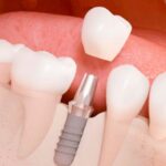 Coronas sobre Implantes: Consigue un Resultado Natural y Estético para tu Implante