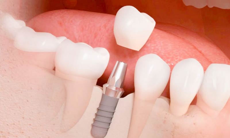 Coronas sobre Implantes: Consigue un Resultado Natural y Estético para tu Implante
