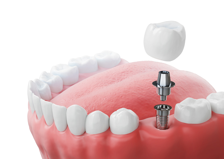 Coronas sobre Implantes
