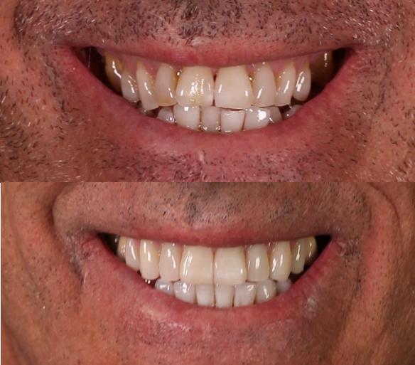 Rejuvenecimiento de la Sonrisa: Tratamientos para Aspecto Más Joven Rejuvenecimiento de la Sonrisa: Tratamientos para Aspecto Más Joven