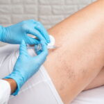 Escleroterapia Eliminar Varices y Arañas Vasculares