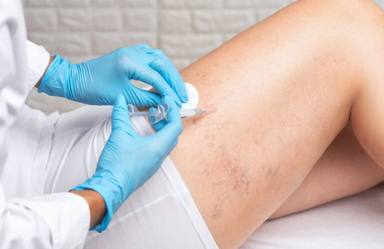 Escleroterapia Eliminar Varices y Arañas Vasculares