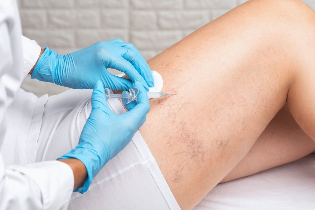 Escleroterapia Eliminar Varices y Arañas Vasculares