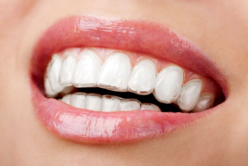 Ortodoncia Estética para Adultos: Opciones Discretas para Alinear tu Sonrisa a Cualquier Edad