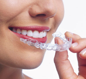 Ortodoncia Estética para Adultos: Opciones Discretas para Alinear tu Sonrisa a Cualquier Edad Ortodoncia Estética para Adultos: Opciones Discretas para Alinear tu Sonrisa a Cualquier Edad