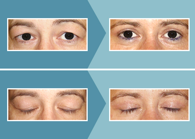 Blefaroplastia sin cirugía, levanta tus parpados caídos y rejuvenece tu mirada. Blefaroplastia sin cirugía, levanta tus parpados caídos y rejuvenece tu mirada.