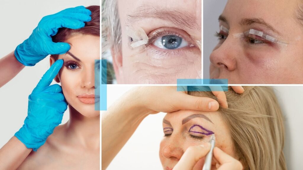 Blefaroplastia sin cirugía, levanta tus parpados caídos y rejuvenece tu mirada. Blefaroplastia sin cirugía, levanta tus parpados caídos y rejuvenece tu mirada.
