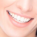 Microcarillas Dentales: Qué Son y Para Qué Sirven