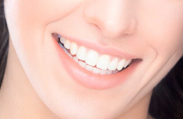 Microcarillas Dentales: Qué Son y Para Qué Sirven