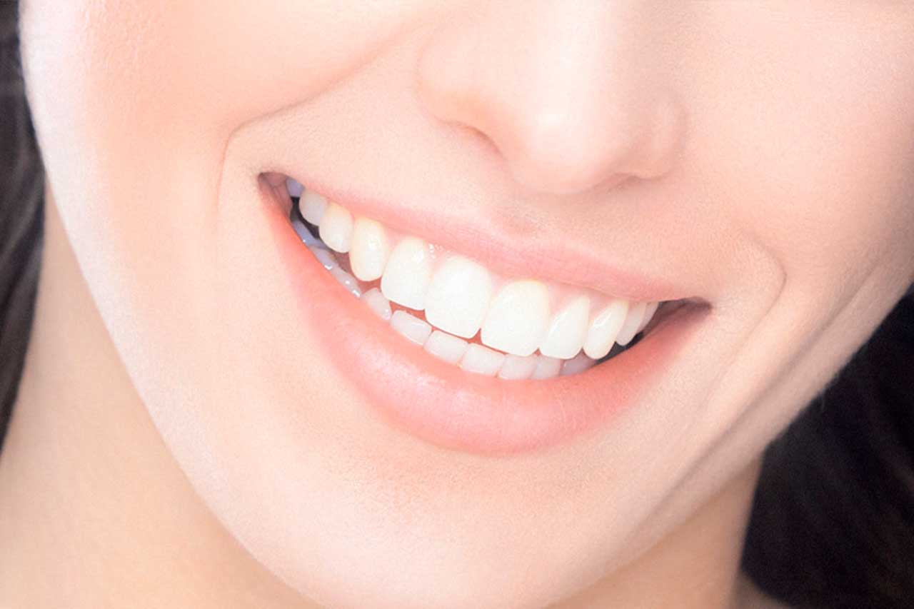 Microcarillas Dentales: Qué Son y Para Qué Sirven