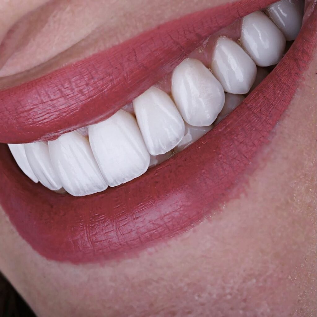Microcarillas Dentales: Qué Son y Para Qué Sirven 