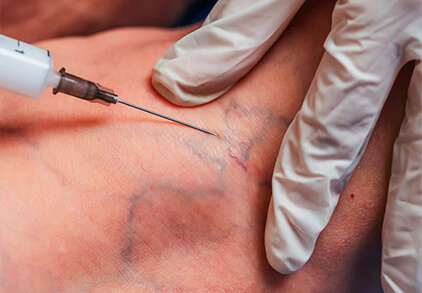 Escleroterapia Eliminar Varices y Arañas Vasculares