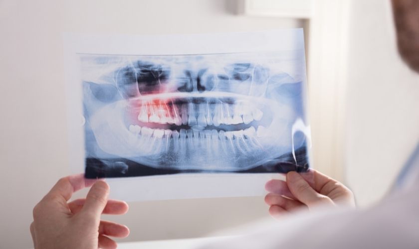 Flemón Dental: Síntomas y Cómo se Trata Flemón Dental: Síntomas y Cómo se Trata