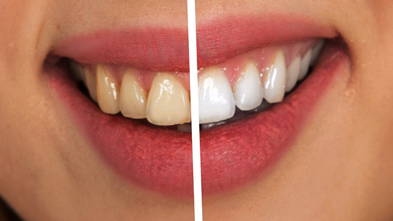 Rejuvenecimiento de la Sonrisa: Tratamientos para Aspecto Más Joven Rejuvenecimiento de la Sonrisa: Tratamientos para Aspecto Más Joven
