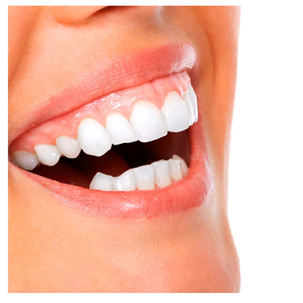 Alargamiento Coronario: La Solución para la Sonrisa Gingival Alargamiento Coronario: La Solución para la Sonrisa Gingival
