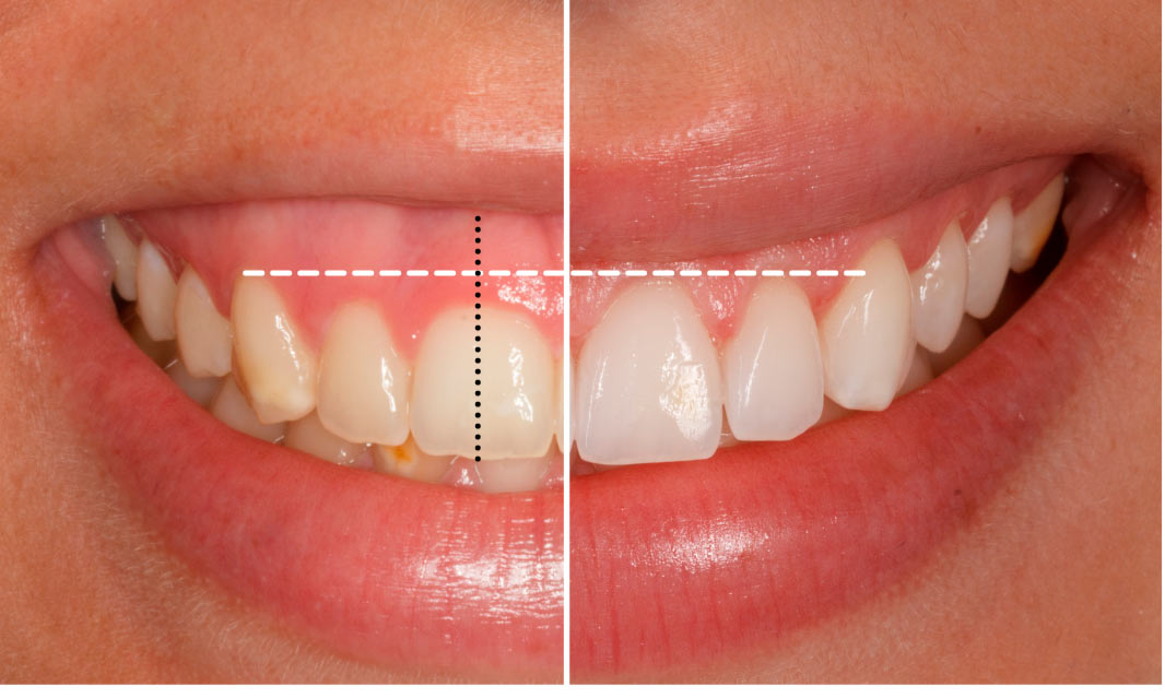 Alargamiento Coronario: La Solución para la Sonrisa Gingival Alargamiento Coronario: La Solución para la Sonrisa Gingival