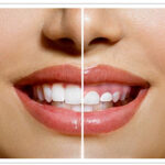 Alargamiento Coronario: La Solución para la Sonrisa Gingival
