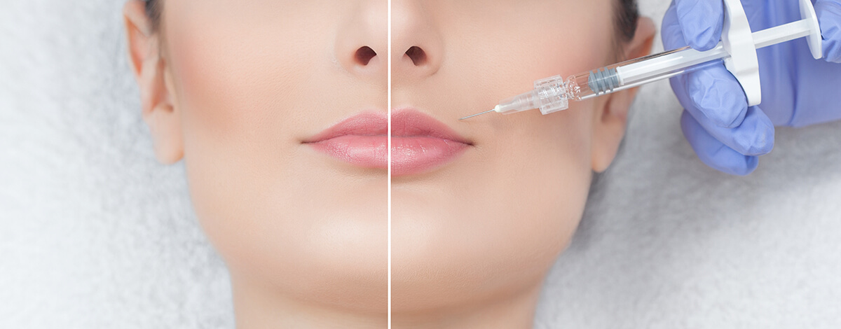 Perfilado y Aumento de Labios con Ácido Hialurónico: Resultado Natural Perfilado y Aumento de Labios con Ácido Hialurónico: Resultado Natural