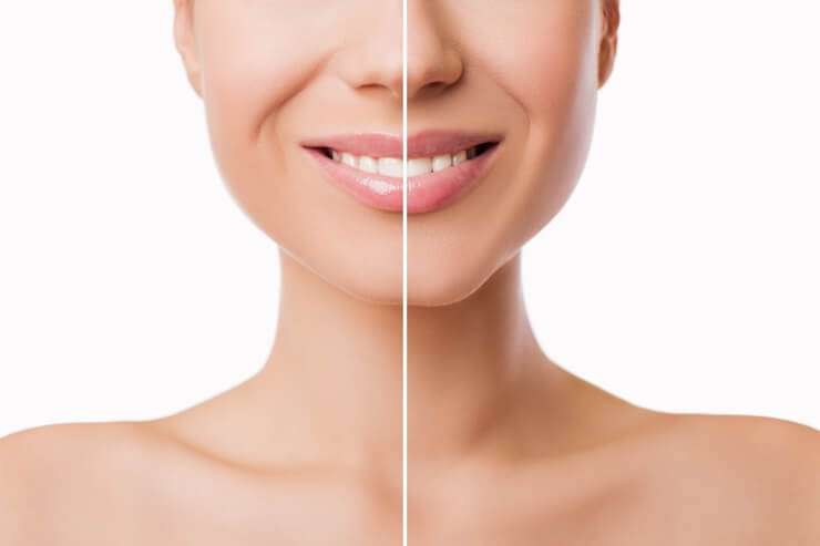 Perfilado y Aumento de Labios con Ácido Hialurónico: Resultado Natural Perfilado y Aumento de Labios con Ácido Hialurónico: Resultado Natural