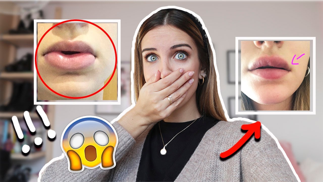 Perfilado y Aumento de Labios con Ácido Hialurónico: Resultado Natural Perfilado y Aumento de Labios con Ácido Hialurónico: Resultado Natural