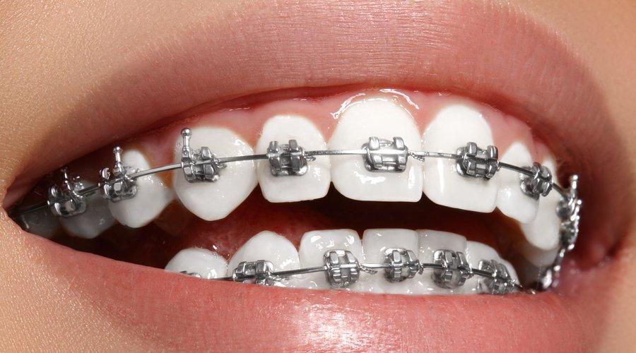 Mantenimiento de Ortodoncia: Cómo Cuidar tus Brackets y Alineadores Correctamente