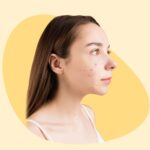 Tratamiento de Cicatrices de Acné: Las Mejores Técnicas para una Piel Lisa