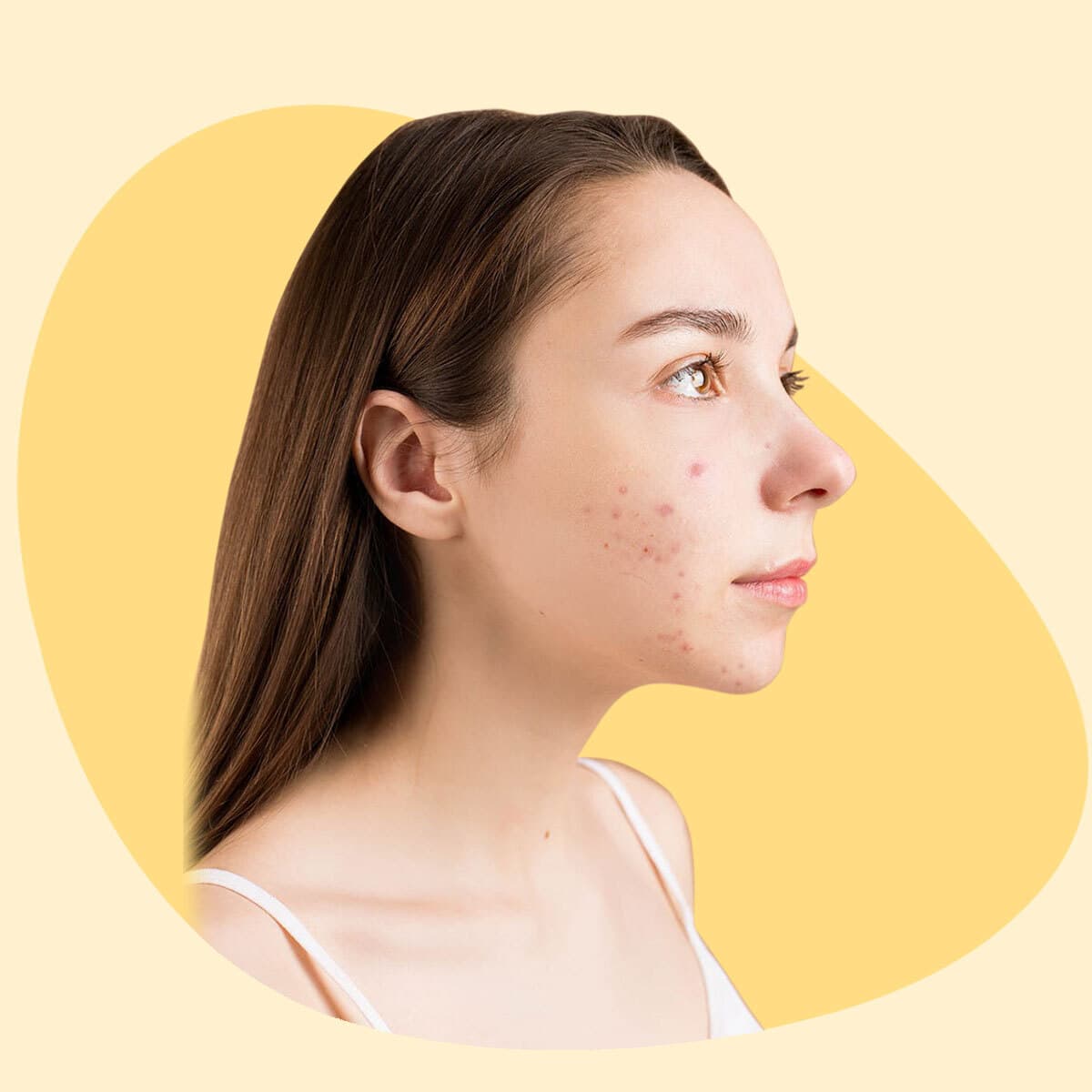 Tratamiento de Cicatrices de Acné: Las Mejores Técnicas para una Piel Lisa