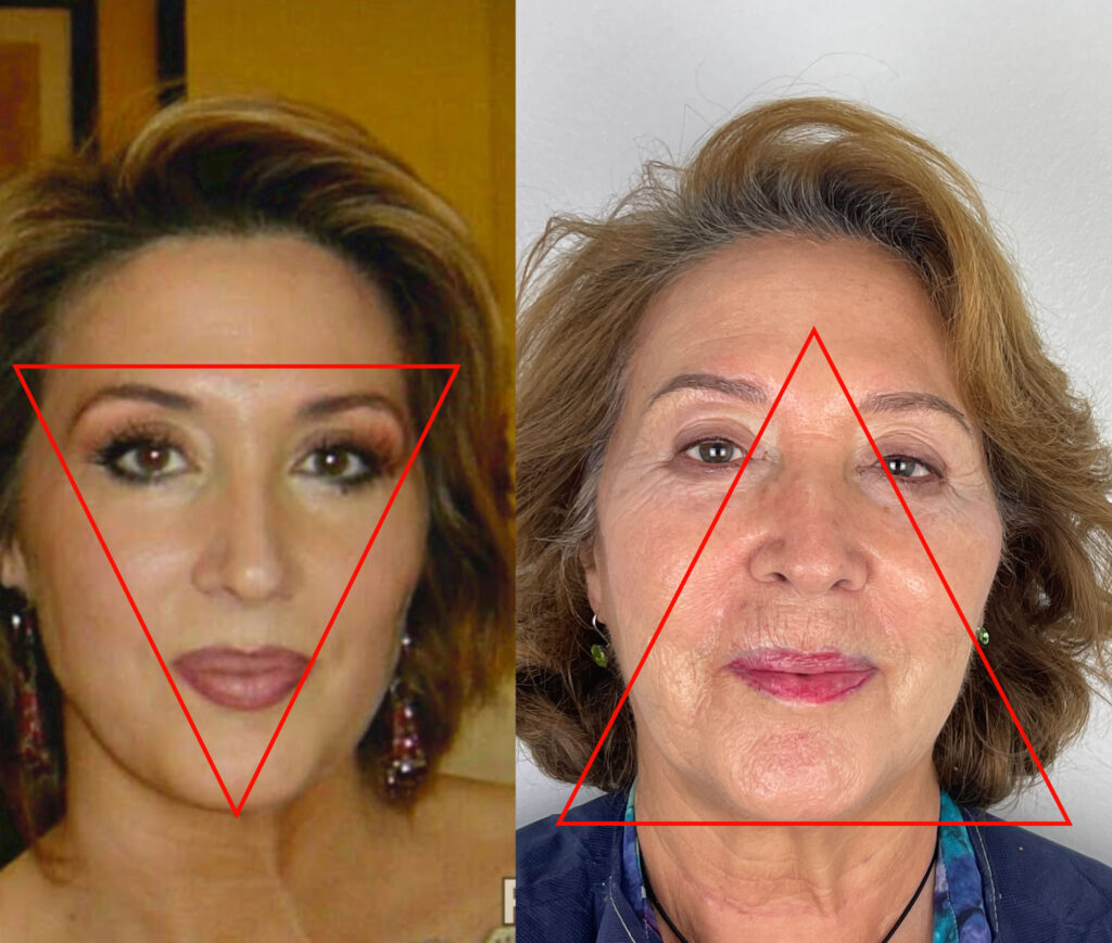 Full Face: Qué es y Cómo Lograr un Equilibrio Estético