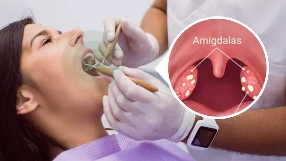 Tonsilolitos (Bolitas blancas en la garganta): Causa del mal aliento Tonsilolitos (Bolitas blancas en la garganta): Causa del mal aliento