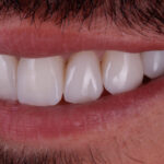 Triángulos negros entre dientes: Cómo cerrarlos sin ortodoncia