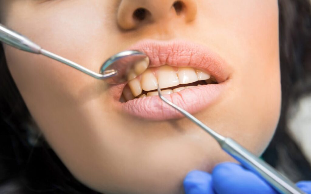 Triángulos negros entre dientes: Cómo cerrarlos sin ortodoncia Triángulos negros entre dientes: Cómo cerrarlos sin ortodoncia