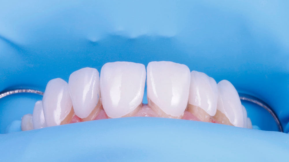 Triángulos negros entre dientes: Cómo cerrarlos sin ortodoncia Triángulos negros entre dientes: Cómo cerrarlos sin ortodoncia