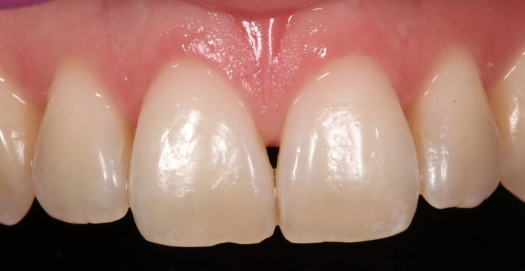 Triángulos negros entre dientes: Cómo cerrarlos sin ortodoncia Triángulos negros entre dientes: Cómo cerrarlos sin ortodoncia