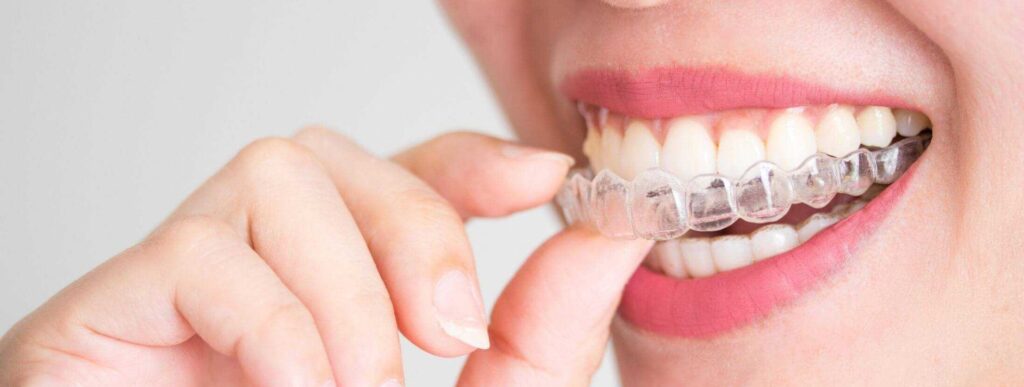 Invisalign vs. Spark: Comparativa de alineadores transparentes