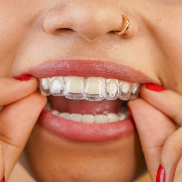 Invisalign vs. Spark: Comparativa de alineadores transparentes