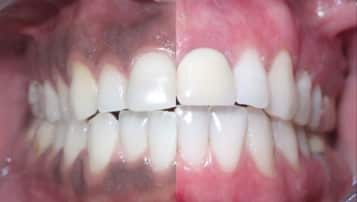 Encías oscuras (Melanosis gingival): Tratamiento de despigmentación Encías oscuras (Melanosis gingival): Tratamiento de despigmentación