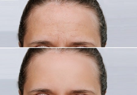 Baby Botox: Qué es y diferencia con el Botox tradicional