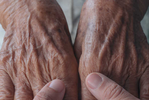 Rejuvenecimiento de manos: Eliminar manchas y venas marcadas