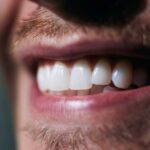 Apiñamiento Dental: Por Qué se Mueven los Dientes y Cómo Solucionarlo