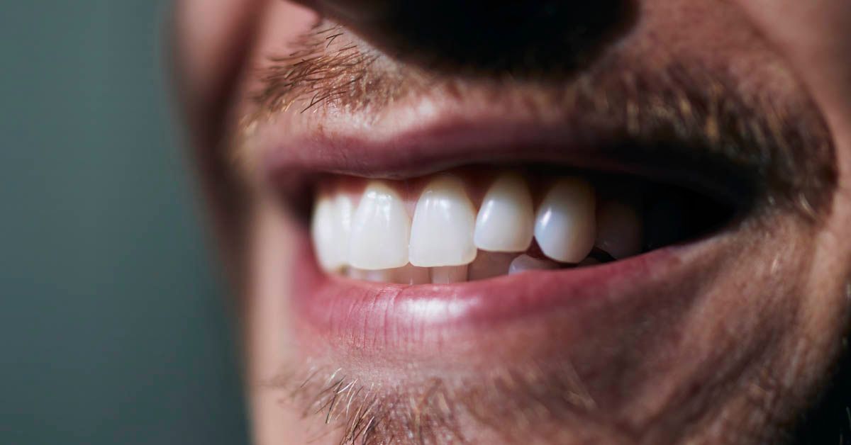Apiñamiento Dental: Por Qué se Mueven los Dientes y Cómo Solucionarlo