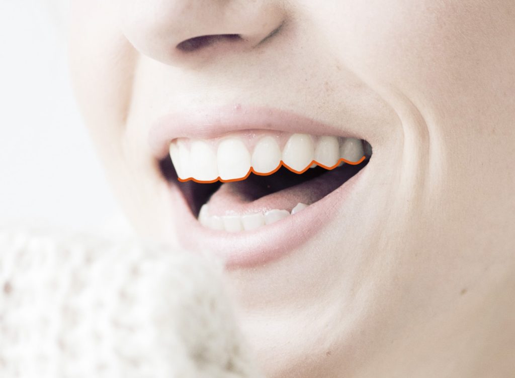 Stripping dental: ¿Duele limar los dientes para ortodoncia?