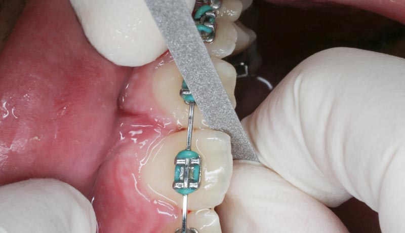 Stripping dental: ¿Duele limar los dientes para ortodoncia?