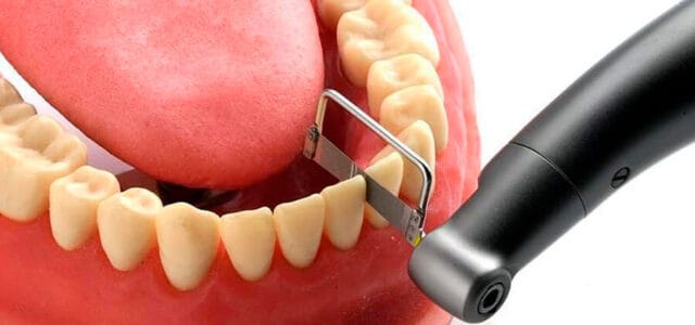 Stripping dental: ¿Duele limar los dientes para ortodoncia?